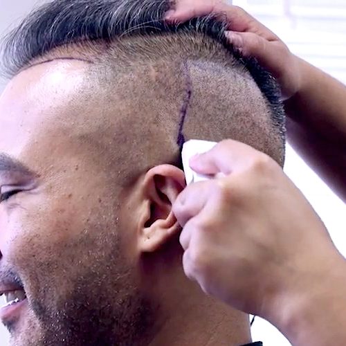 FUE-HAIR-TRANSPLANT-06-1